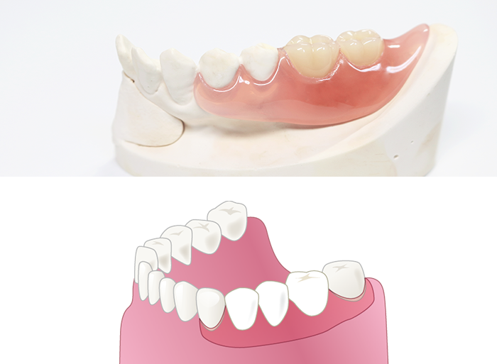 【自由診療の入れ歯】